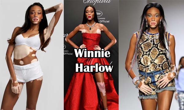 Winnie Harlow Bio, Age, Height, Early Life, Career, Net Worth and More