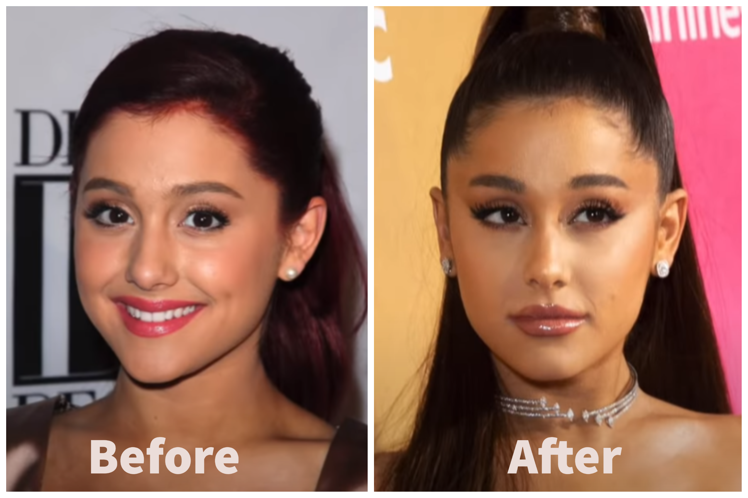 Ariana Grande Before and After Plastic Surgery