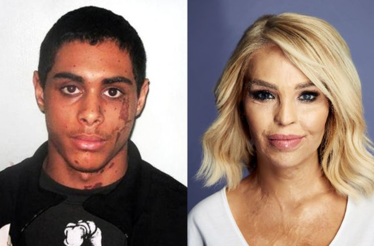 Katie Piper (Right), Victim of a 2008 facial acid attack by a man named Stefan Sylvestre (Left) which was arranged by her ex-partner, Daniel Lynch