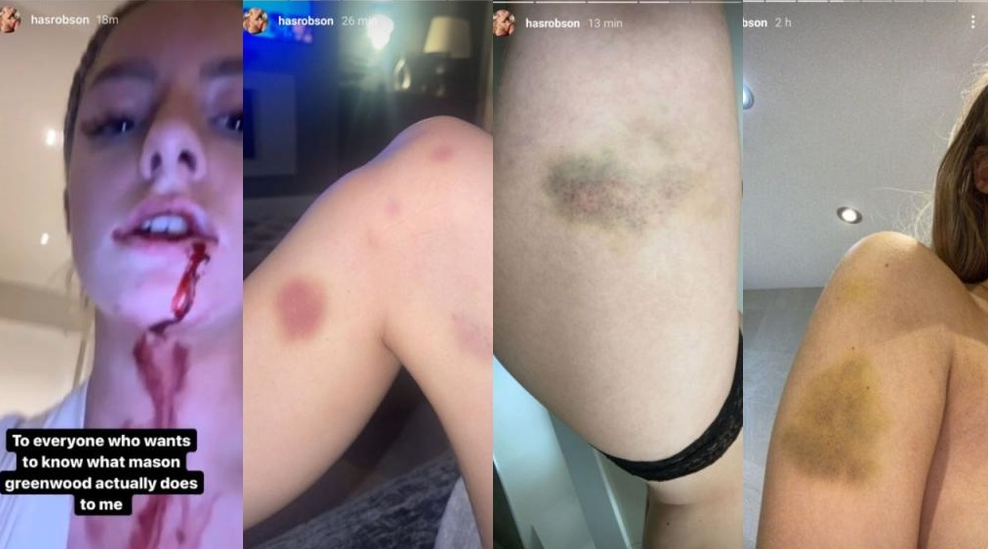 Harriet posted a series of pictures on her Instagram stories showing herself bruised from alleged beatings Mason