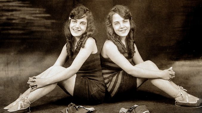 10 World's Most Famous Conjoined Twins